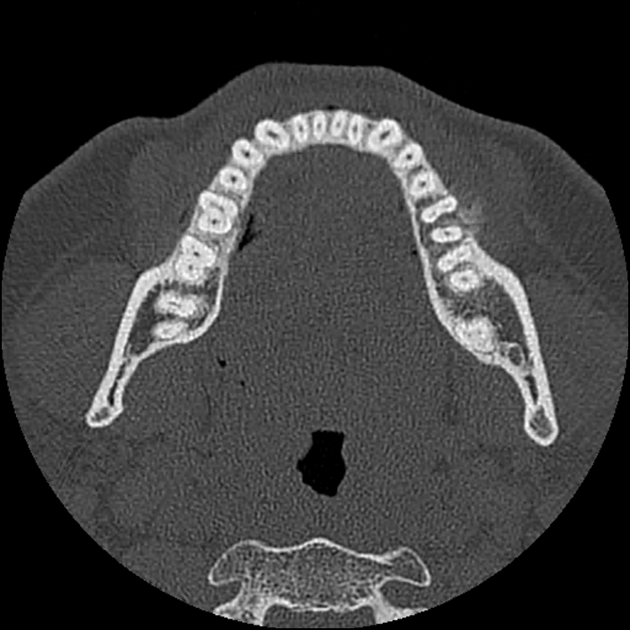 Figure 4 for case Chondroblastic osteosarcoma of the mandible